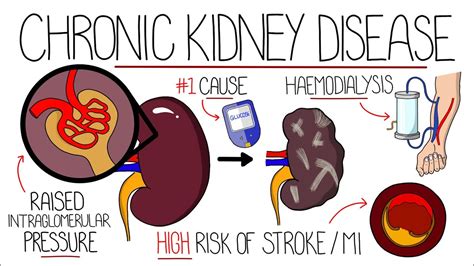 chronic kidney disease near occidental|Understanding Kidney Disease .
